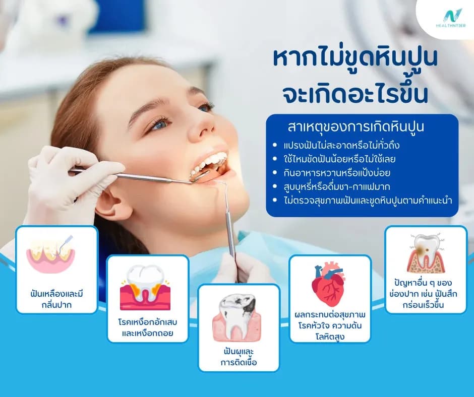 ภาพประกอบด้านสุขภาพ: หินปูนในฟัน: หากไม่ขูดจะเกิดอะไรขึ้น? ดูแลฟันให้แข็งแรง