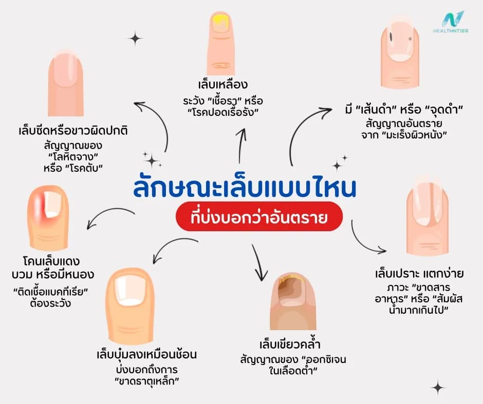 บทความสุขภาพ: ลักษณะเล็บแบบไหนอันตราย? สัญญาณเตือนสุขภาพที่คุณอาจมองข้าม