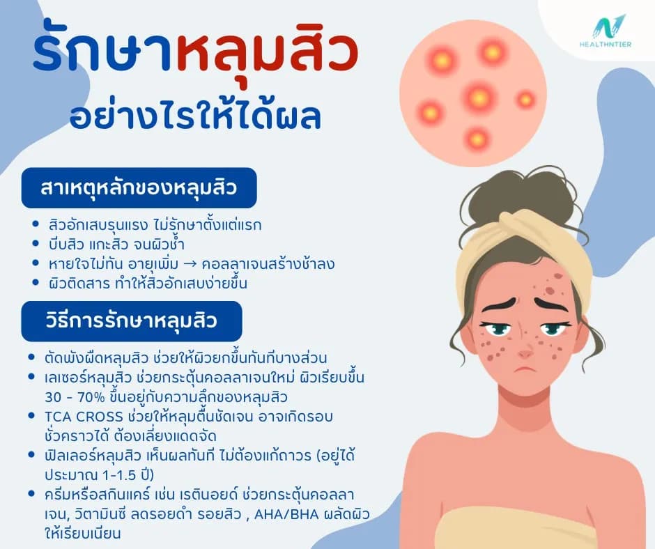 ภาพประกอบบทความ: หลุมสิวรักษายังไง? วิธีรักษาหลุมสิวที่ได้ผลจริง เห็นผลไว อัปเดตล่าสุด