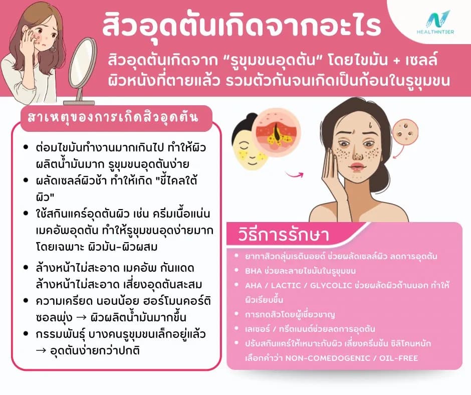 ภาพประกอบบทความ: สิวอุดตันเกิดจากอะไร? สาเหตุ วิธีรักษา และวิธีป้องกันไม่ให้กลับมาเป็นซ้ำ