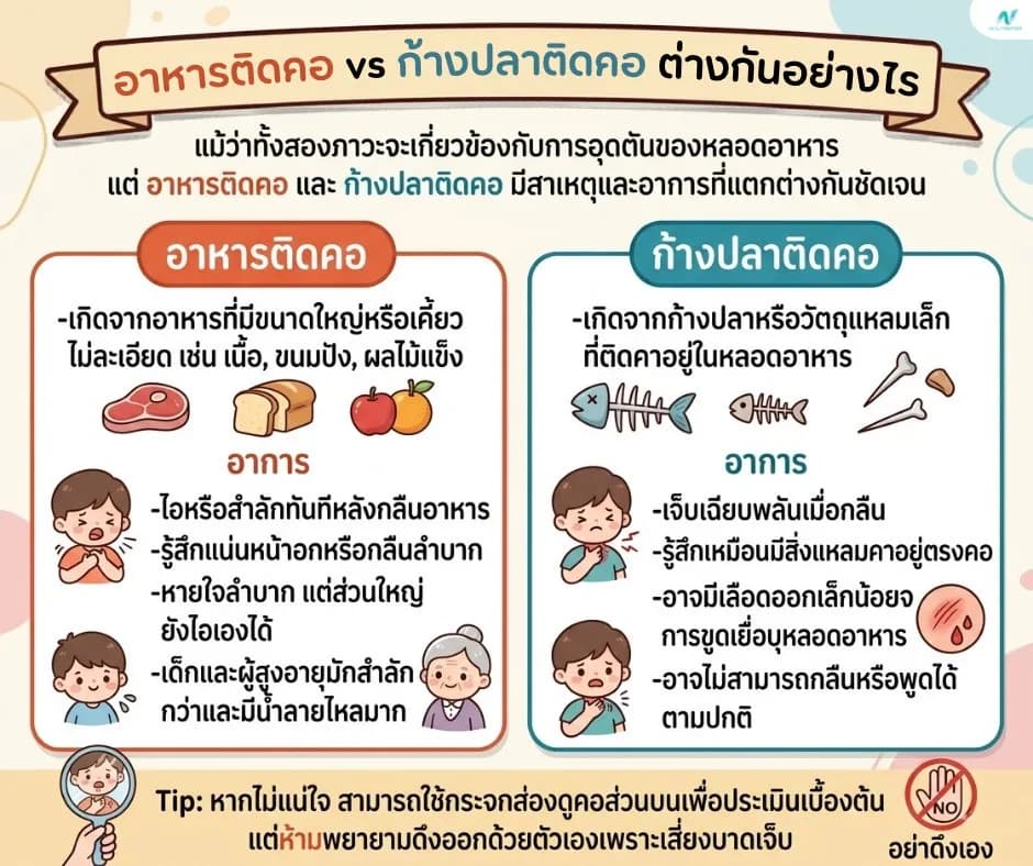 ภาพประกอบ: อาหารติดคอ vs ก้างปลา – จุดต่าง อาการ และการรักษาที่ปลอดภัย