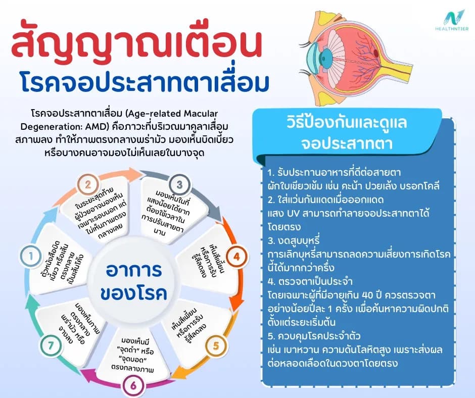 ภาพประกอบด้านสุขภาพ: จอประสาทตาเสื่อม อาการเป็นยังไง? ป้องกันอย่างไรไม่ให้สายตาเสื่อมเร็ว