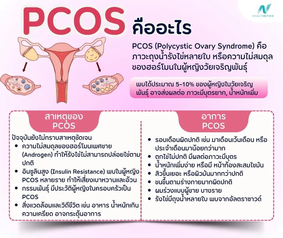ภาพประกอบด้านสุขภาพ: PCOS คืออะไร? อาการ สาเหตุ และวิธีดูแลตัวเองให้ปลอดภัย