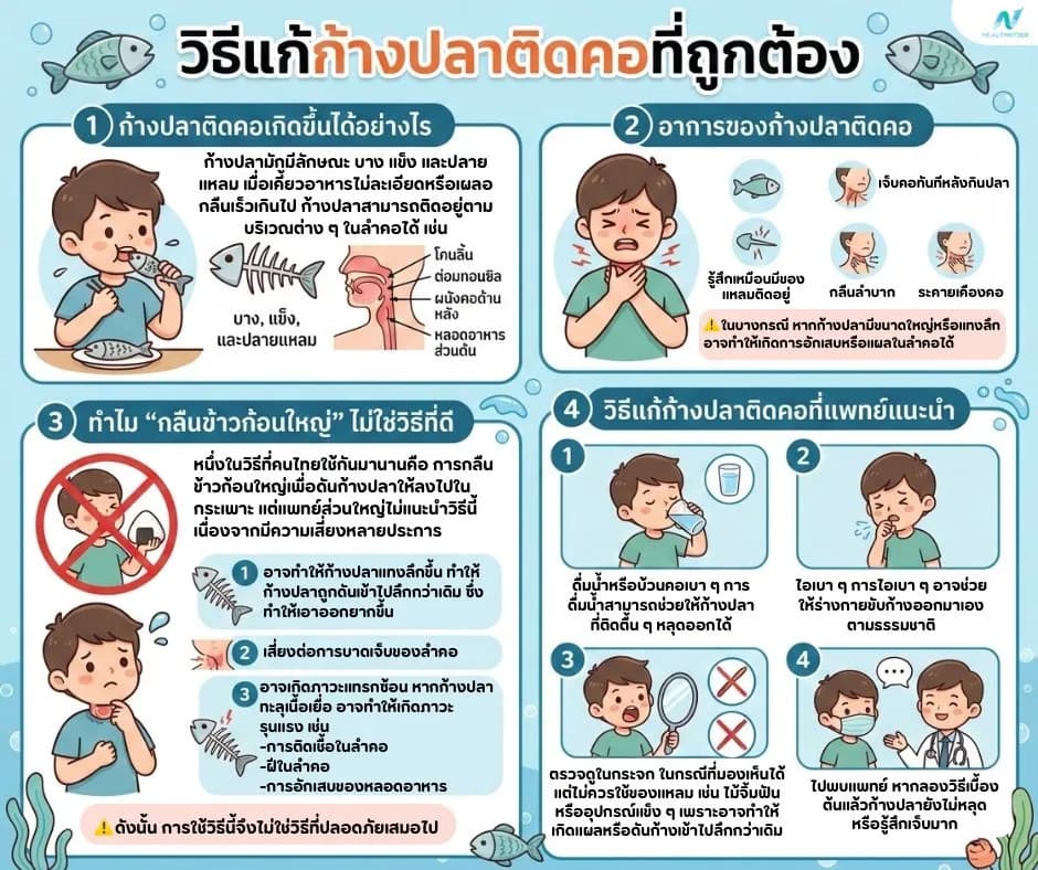 ภาพประกอบด้านสุขภาพ: วิธีแก้ก้างปลาติดคอที่ถูกต้องและปลอดภัย