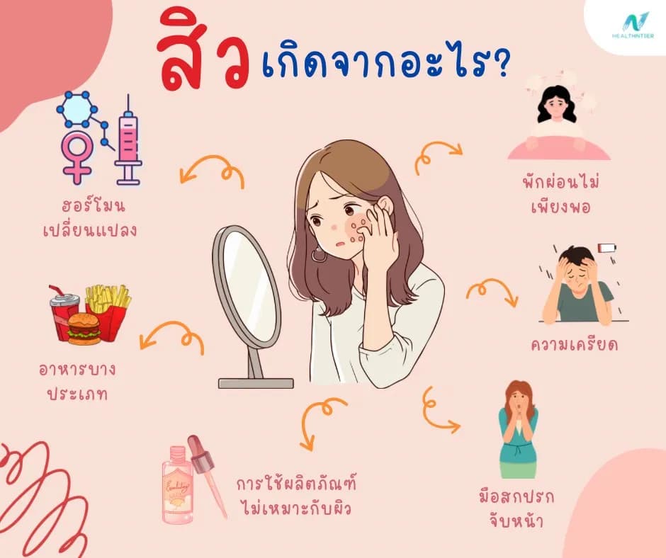 ภาพประกอบบทความ: สิวเกิดจากอะไร? รวมสาเหตุยอดฮิตและวิธีแก้ไขแบบตรงจุดเพื่อหน้าใสไร้สิว