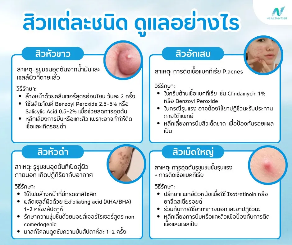 ภาพประกอบบทความ: วิธีรักษาสิวแต่ละชนิด สิวหัวขาว-ดำ-อักเสบ-เม็ดใหญ่