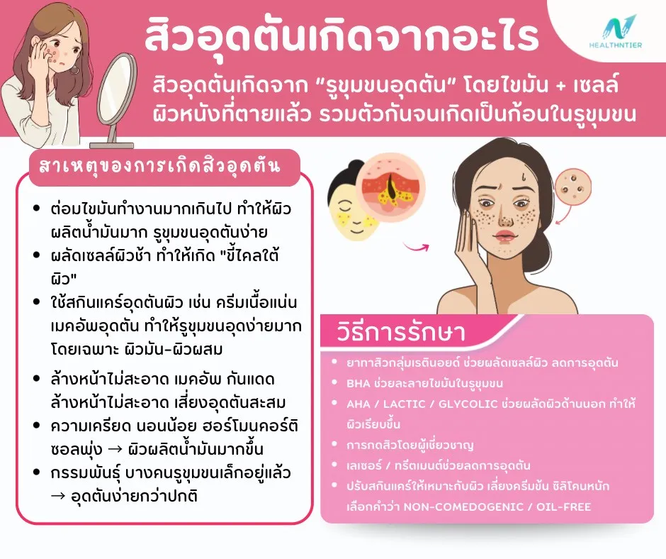 ภาพประกอบบทความ: สิวอุดตันเกิดจากอะไร? สาเหตุ วิธีรักษา และวิธีป้องกันไม่ให้กลับมาเป็นซ้ำ