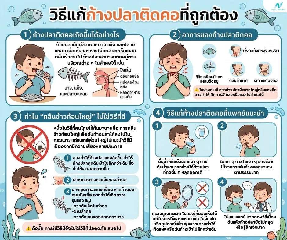ภาพประกอบด้านสุขภาพ: วิธีแก้ก้างปลาติดคอที่ถูกต้องและปลอดภัย